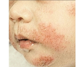Dermatite atpica