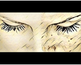 Melasma
